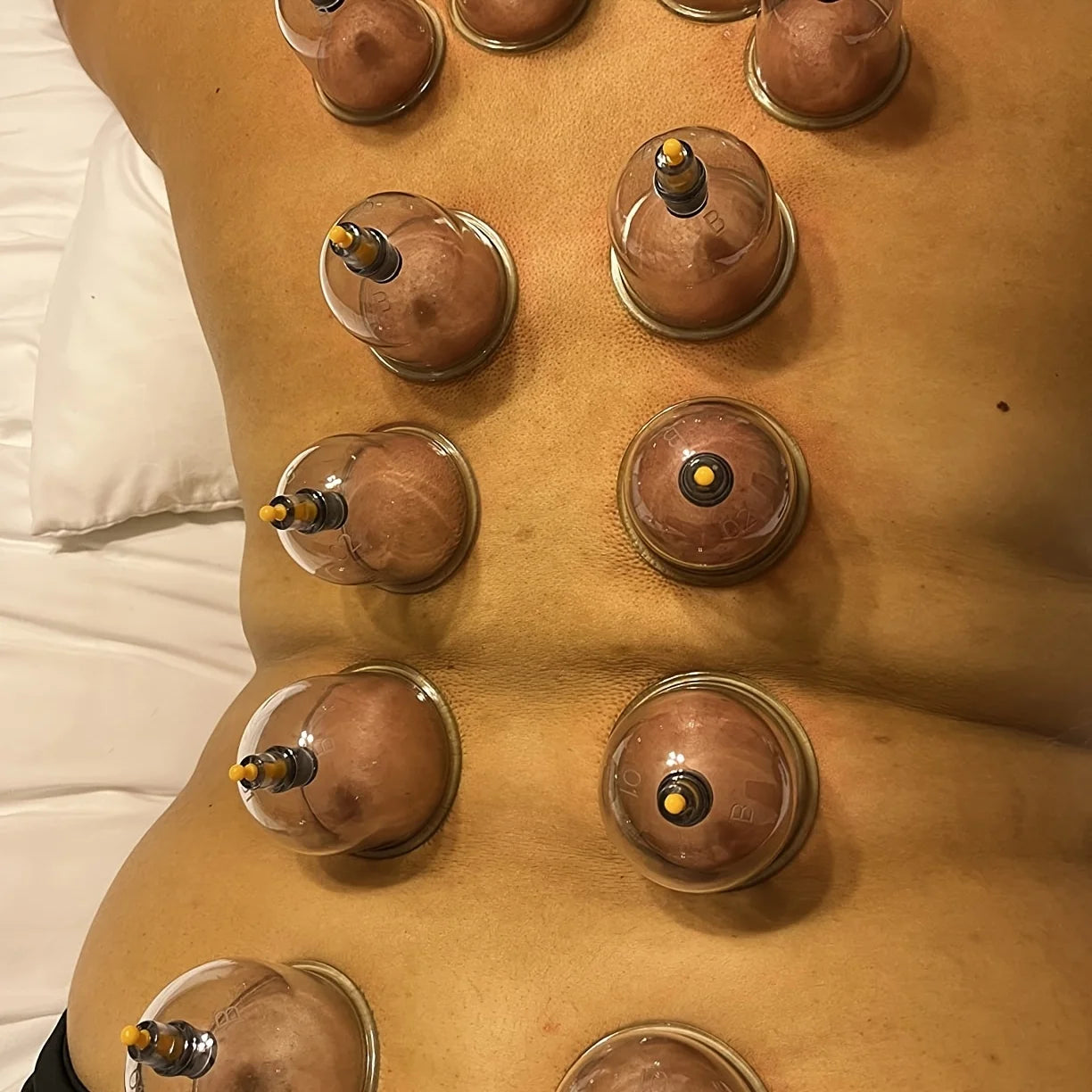 32-Piece Cupping Therapy Set – Vacuum Massage Kit with Hand Pump - Image 3