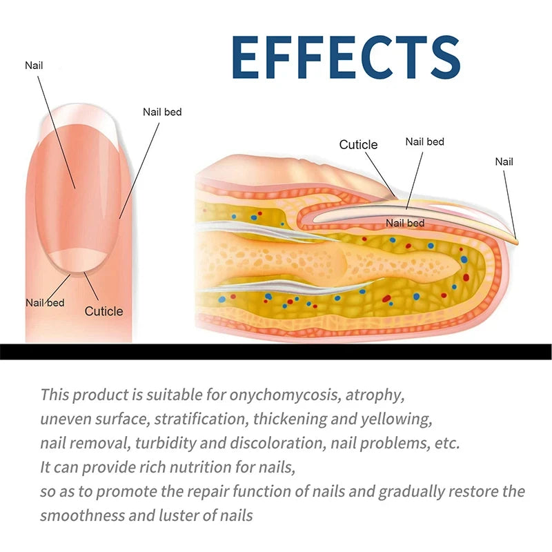 32/64PCS Foot & Nail Repair Patch – Ingrown Toenail & Fungal Treatment Stickers - Image 2